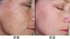 超皮秒價(jià)格，超皮秒廠家哪個(gè)比較好？