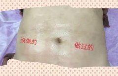 去妊娠紋機(jī)器多少錢一臺(tái)？美容院去除妊娠紋機(jī)器設(shè)備價(jià)格
